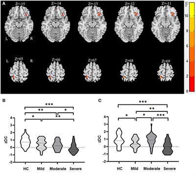 Abnormal Degree Centrality in White Matter Hyperintensities: A Resting-State Functional Magnetic Resonance Imaging Study